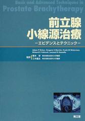 前立腺小線源治療 エビデンスとテクニック