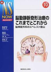 脳動静脈奇形治療のこれまでとこれから 脳神経外科のエベレスト登山 （新ＮＳ ＮＯＷ）