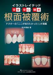 イラストレイテッド安全・安心・確実 根面被覆術 ドクターの「ここが