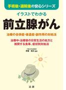 イラストでわかる　前立腺がん