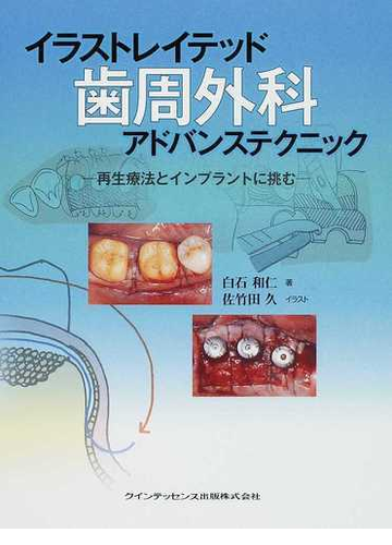 イラストレイテッド歯周外科アドバンステクニック 再生療法とインプラントに挑むの通販 白石 和仁 佐竹田 久 紙の本 Honto本の通販ストア