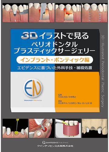 ３ｄイラストで見るペリオドンタルプラスティックサージェリー インプラント ポンティック編 エビデンスに基づいた外科手技 補綴処置の通販 中田 光太郎 木林 博之 紙の本 Honto本の通販ストア